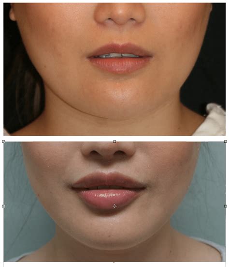 upper lip lift without surgery - Captions Time