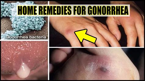 Natural home remedies for gonorrhea to cure the symptoms in men and women without seeing a ...