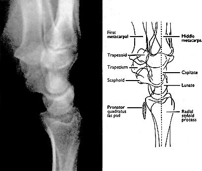 ABC of Emergency Radiology: THE WRIST | The BMJ