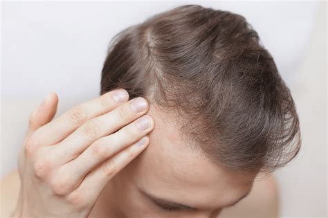 What Causes Scalp Hair Loss at Dorothy Rose blog