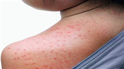 Sweat Rash Home Remedies: स्वैट रैश या हीट रैश से बचाव के लिए घरेलू उपाय - Sweat Rash Home ...