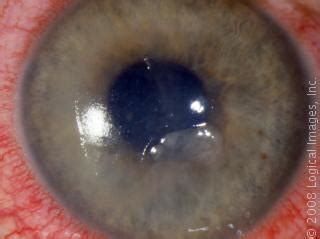 Corneal Abrasion - Insight Eye Specialists - Utah Eye Doctors | Insight Eye Specialists - Utah ...