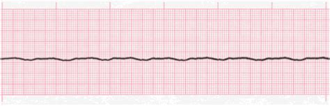 Asystole – First Aid for Free