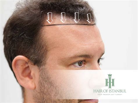 Hair Transplant for Receding Hairline (The Ultimate Guide)