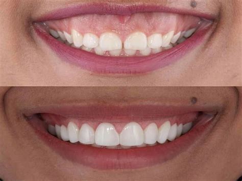 laser gum contouring | Gummy smile surgery, Dental, Dental veneers