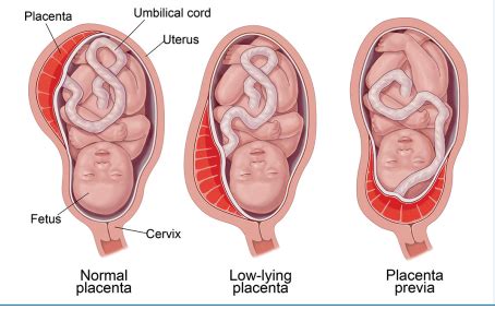 Low-lying placenta at 20 week scan - University Hospitals Sussex NHS Foundation Trust