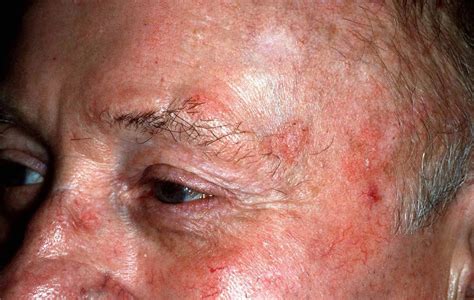 Actinic Keratosis Histology