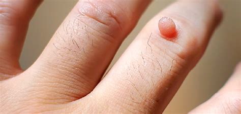 Skin Warts Treatment