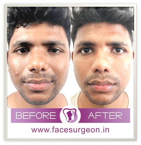 Why Is Nose Reconstruction Surgery in India Booming?