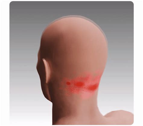 GFOUK™ CooldownScalp Eczema Treatment Roller - Wizzgoo