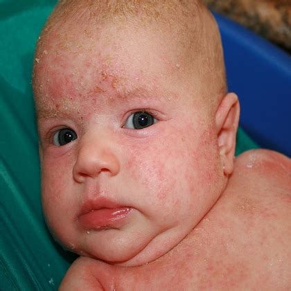 Eczema as related to Acne - Pictures