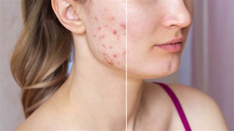 Best Acne Treatment Dermatologist | Acne Clinic Toronto