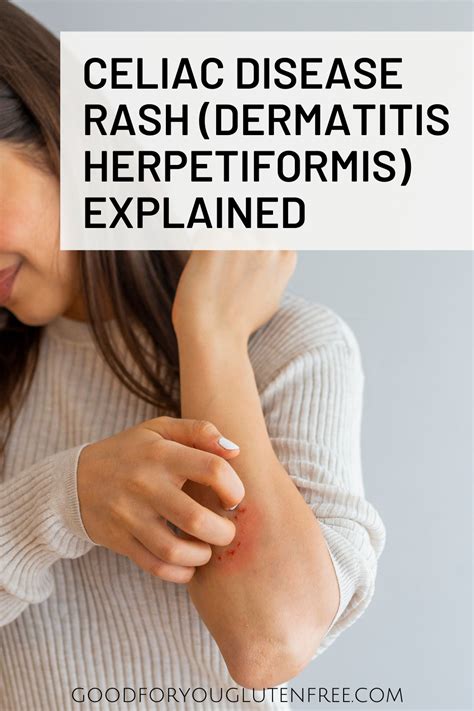 Celiac Disease Rash (Dermatitis Herpetiformis) Explained - Good For You ...