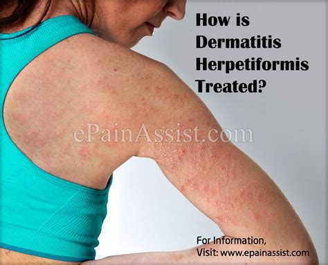 Dermatitis Herpetiformis | Dermatitis herpetiformis, Dermatitis, Rash treatment