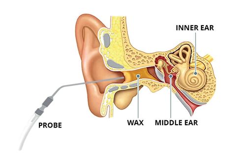 Get Ear Wax Removal in Chelmsford - Colecross Pharmacy