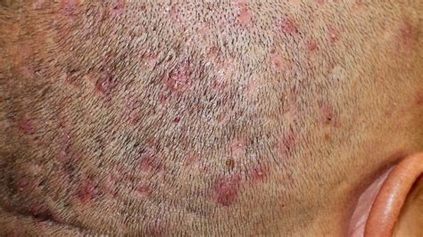 Folliculitis Scalp