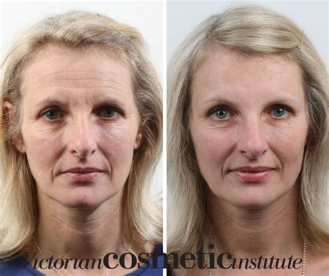 Forehead Wrinkles Clinic Melbourne - Victorian Cosmetic Institute