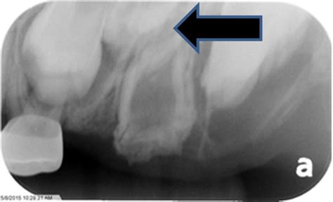 Regional Odontodysplasia - An Unusual Development