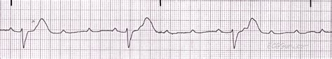 ECG Basics: Third-degree AV Block, Complete Heart Block | ECG Guru - Instructor Resources