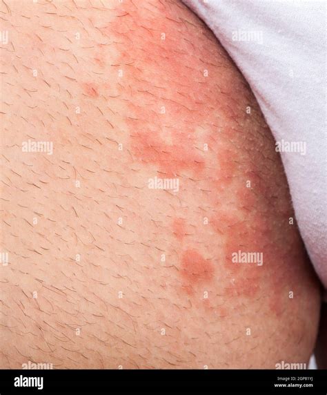 Eczema groin atopic dermatitis symptom of skin texture Stock Photo - Alamy