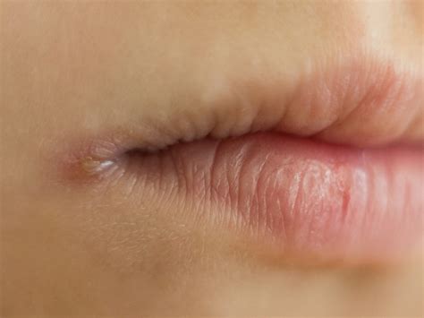 What foods cause angular cheilitis?