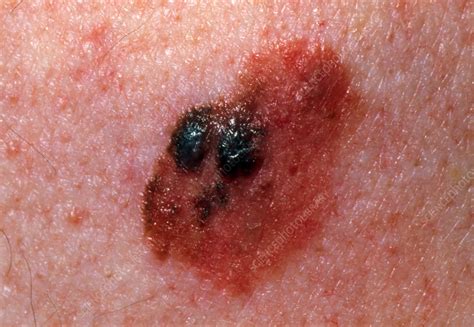 Close-up of a malignant melanoma on an elderly man - Stock Image - M131/0311 - Science Photo Library