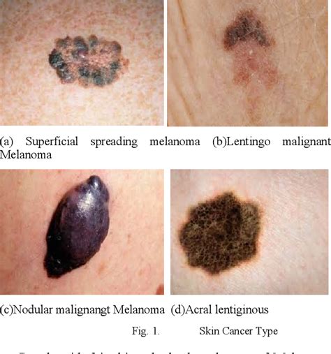 Figure 1 from Automated Melanoma Types and Stages Classification for dermoscopy images ...