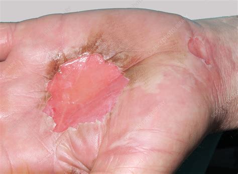 Second-degree burn - Stock Image - C059/0648 - Science Photo Library