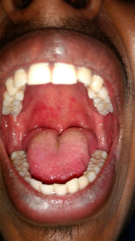 Mouth Ulcers On Back Of Throat