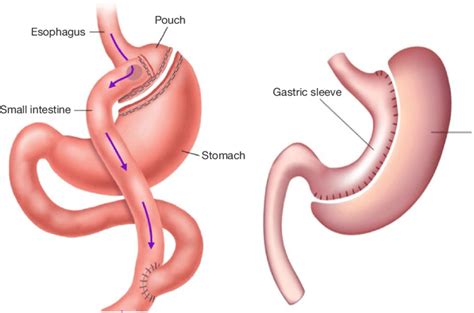 What is Roux-en-Y Gastric Bypass (RYGB) Procedure? | by Dr. Sukhvinder Singh Saggu - COMS Clinic ...