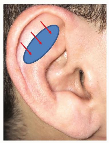 External Ear: Perichondritis, Lacerations, Auricular Hematoma ...