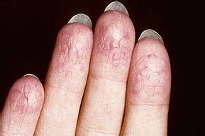 Eczema On Fingers Causes