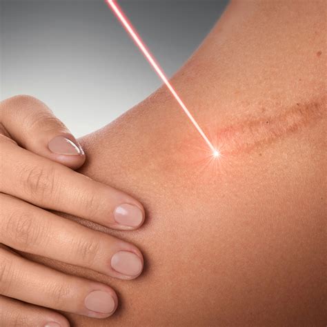 Laser Treatments - Dermamax Medical Center