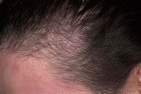 What is Anagen Effluvium Hair Loss and Ways To Treat It – Traya