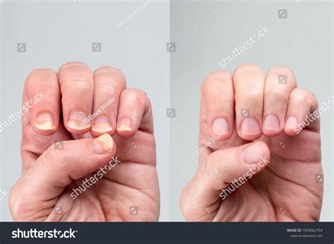 38 Tinea Before After Images, Stock Photos & Vectors | Shutterstock