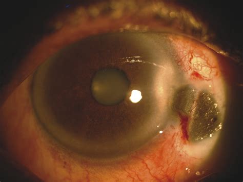 Complications of Pterygium Surgery | Ento Key