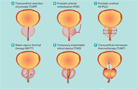 What is the role of minimally invasive surgical treatments for benign prostatic enlargement ...