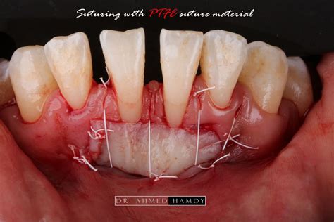 free gingival graft