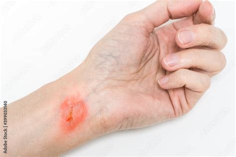 Burn of a skin on woman’s hand isolated on white, burst blister on ...