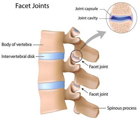 Arthropathy definition, facet arthropathy, lumbar facet arthropathy