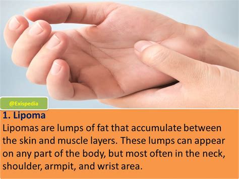 4 Common Types of Lumps on the Wrist - Exis Pedia