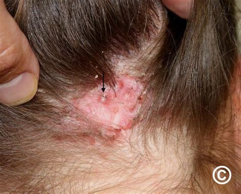 Folliculitis Scalp