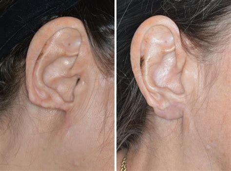 Earlobe Repair Photos | Miami, FL | Patient 1303