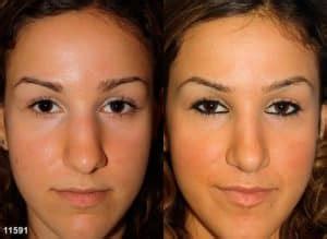 8 Common Signs of a Bad Rhinoplasty - Philip Miller, MD, FACS