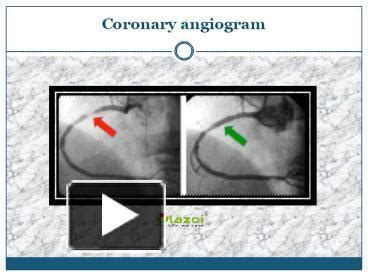 PPT – coronary angiogram PowerPoint presentation | free to download - id: 891bfa-MjBjO