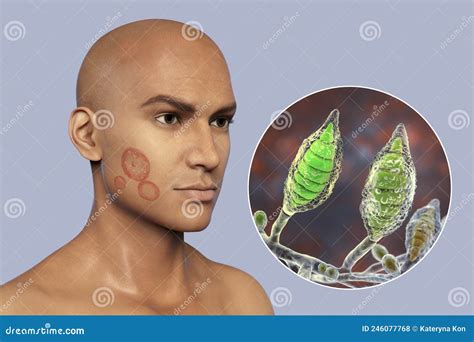 Microsporum Canis Fungal Infection, 3D Illustration Stock Illustration ...