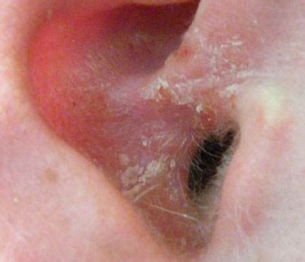 Dry Skin in Ears, Inside Ear Canal, Itchy, Flaky Skin Behind Ears, Inside, Around, Treatment ...