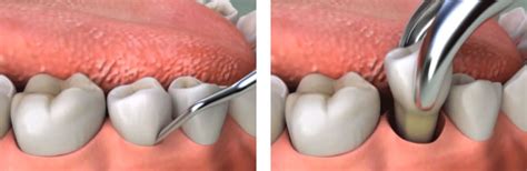 Teeth Extraction in Dubai AED 350 - Wisdom tooth Removal - Cost ...