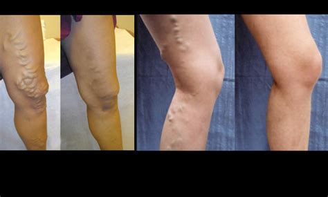 Varicose Veins Symptoms & Treatment | UCSF Radiology