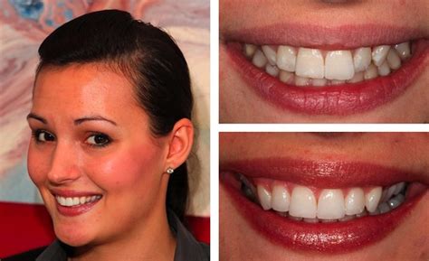 Lingual Braces Before and After – What A Transformation | Blog